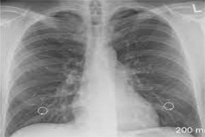 Pancreatitis Associated with Covid-19 And Relationship with A Healthy Lifestyle