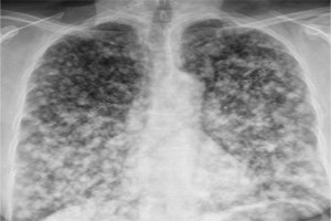 Program Against Cancer In Congo, Democratic Republic