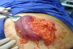 Superior Mesenteric Artery: Clinical Case