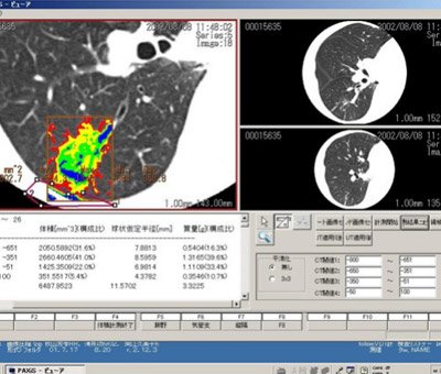 On the Imaging Modalities for Lung Cancer Screening: Low-Dose CT Scan Could Lead to a Significant Reduction of Mortality Rates of the Patient