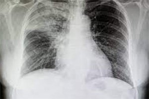 Program Against Cancer in Comoros