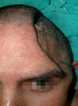 Improvement of Diffuse Axonal Damage and Sinking Flap Syndrome Post Craneoplasty