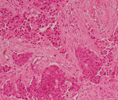 Synchronous Bilateral Breast Carcinoma: Case Report With Review