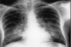 Maintenance Therapy or Metronomic Treatment Replacement Intravenous Phase in Acute Lymphoblastic Leukemia During COVID-19 Pandemic: New Strategy