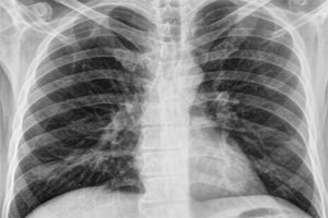 Program Against Cancer In Congo, Republic