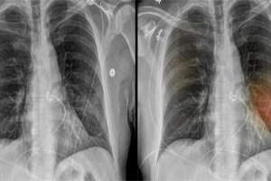 Siringomielia, Report of A Clinical Case and Bibliographic Review