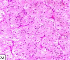 Oncocytoma of The Parotid: A Rare Entity