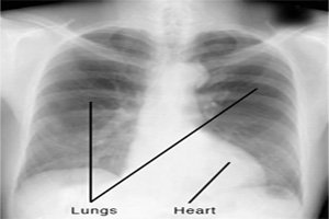 Intervention of Sleep Quality in The Onset of Concomitant Symptoms in Hospitalized Patients