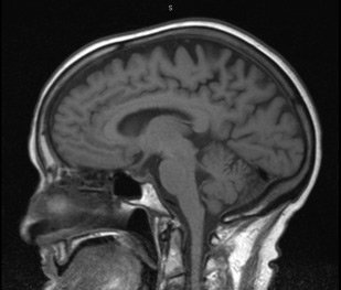 Terapeutic of the Use of Chewing Gum in their Different Presentations to Minimizel to Inertia and Sleep Deprivation