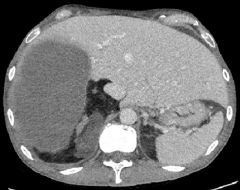 Retroperitoneal Malignant Fibrous Histiocytoma