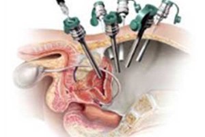Laparoscopic Versus Robot-Assisted Radical Prostatectomy: Comparison of Outcomes of A Single Surgeon